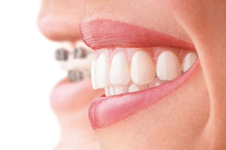 Diğer Diş Teli Tedavisinin Diğer Diş Düzeltme Yöntemlerinden Farkı Nedir?