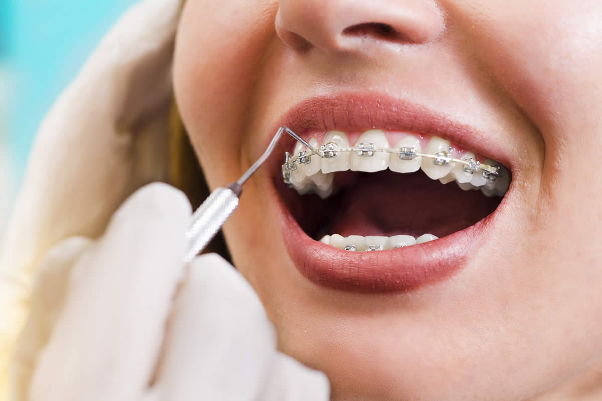 Diş Teli Tedavisi Kimlere Uygulanır?